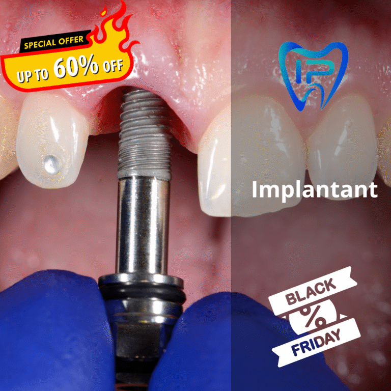 Zubni implantat – Trajno rješenje za nedostatak zuba (Black Friday ponuda)
